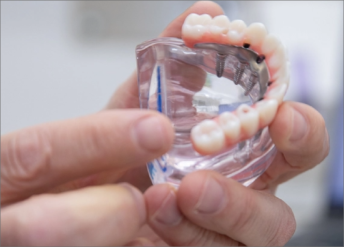 overdentures