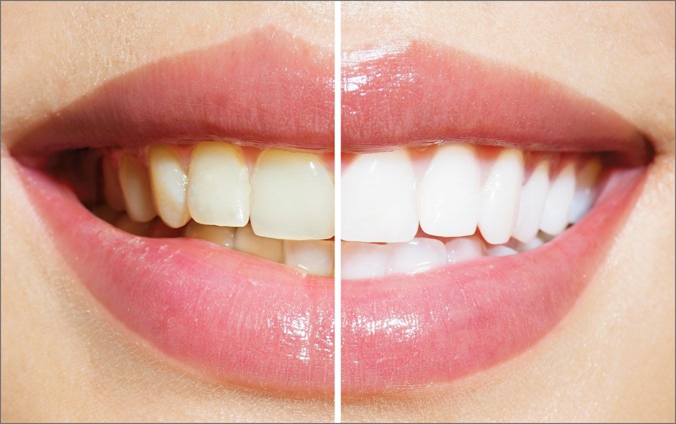 teeth-whitening