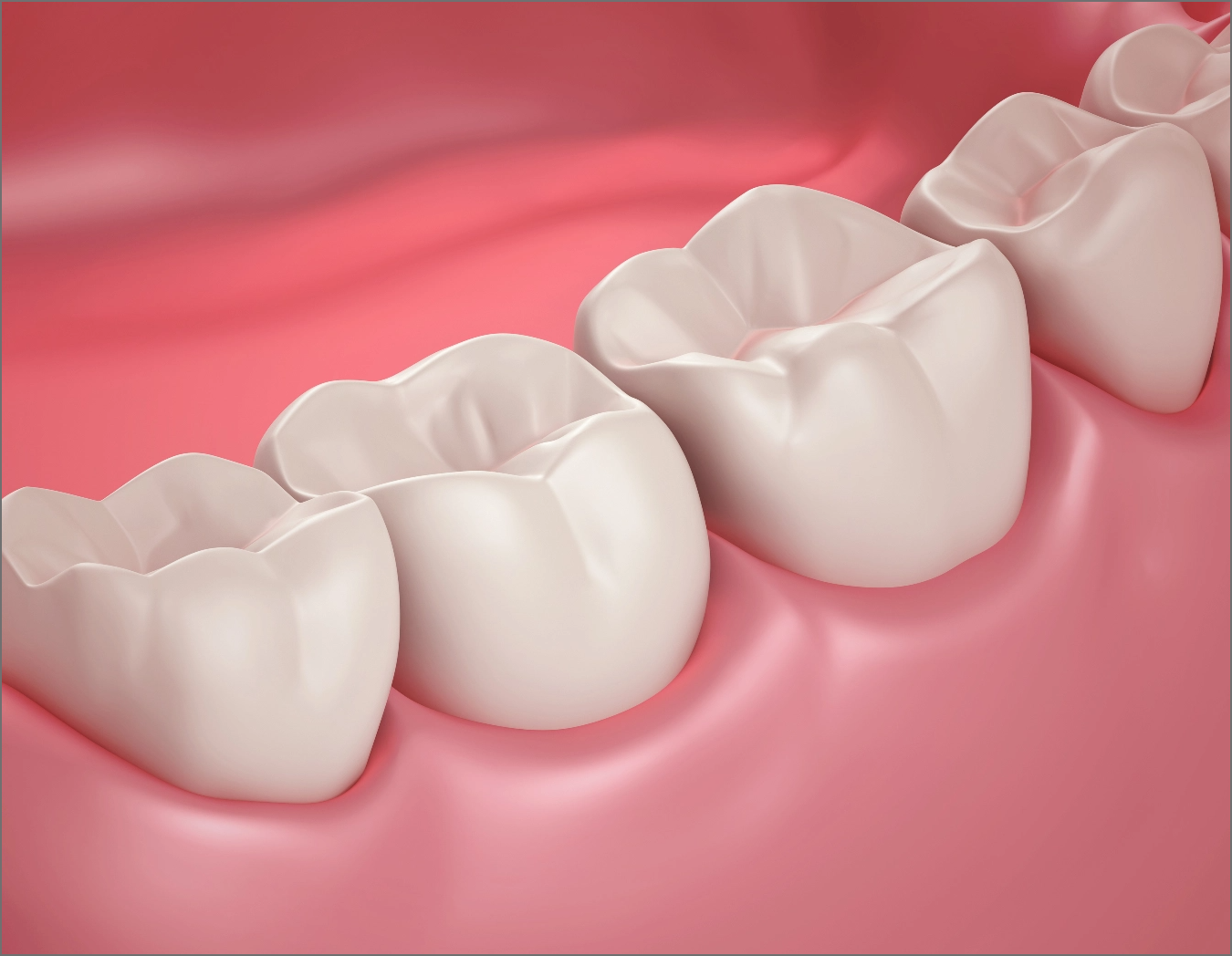 white-bonded-fillings
