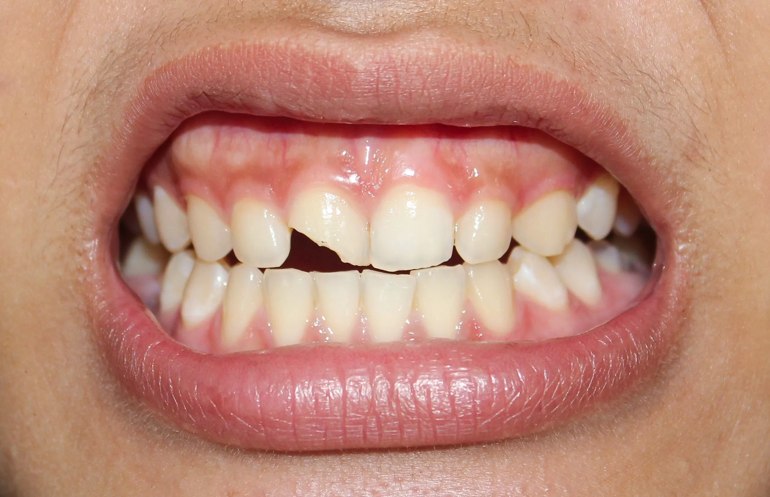 broken teeth